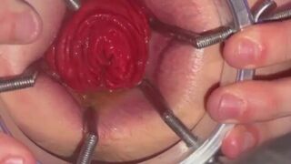 Getting my mancunt spread WIDE by huge anal speculum!